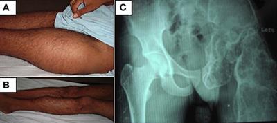 Co-administration of Systemic and Intralesional Zoledronic Acid in a Case of Fibrous Dysplasia: A Potentially Novel Therapy